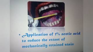 Toluidin Blue staining procedure for early detection of oral cancerous lesion [upl. by Nnazus]