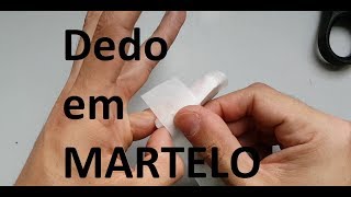 Dedo em Martelo  Tratamento conservador [upl. by Jehiel]