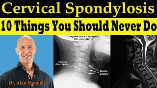 How To Overcome Cervical Pinched Nerve And Radiculopathy quotNo Worriesquot [upl. by Aiepoissac177]