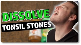 Tonsil Stones Home Remedies [upl. by Dymoke]