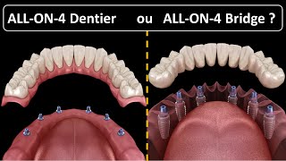 All on 4  Type de prothèse  Dentier ou Bridge [upl. by Borroff552]