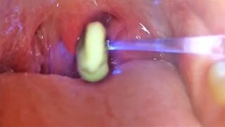 Worlds Greatest Tonsil Stone Removals 2 [upl. by Ehc]