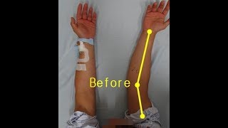 Elbow valgus deformitycubitus valgus surgery by Dr Ahn [upl. by Dragde416]