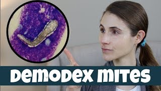 DEMODEX MITES ON YOUR SKIN DR DRAY [upl. by Toland103]