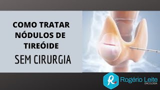 Como Tratar Nódulo De Tireoide Sem Cirurgia Dr Rogério Leite [upl. by Charmane802]