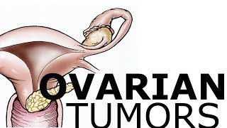 Ovarian Pathology amp Tumors [upl. by Glen]