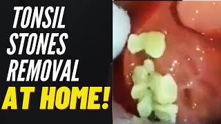 Tonsil Stones Removal Causes and Treatment [upl. by Aleak]