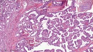 Papillary Thyroid Carcinoma  Histopathology [upl. by Gimble]