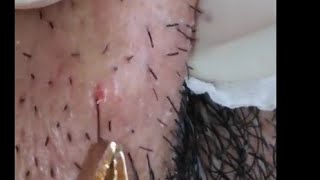 Ingrown Hairs Extraction  Infected Ingrown Hair Cyst Treatment [upl. by Capps]