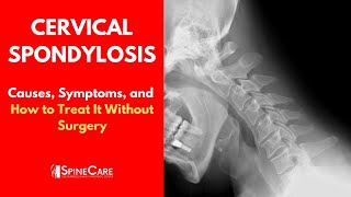 Cervical Spondylosis Causes Symptoms and Treatment [upl. by Enohpets]