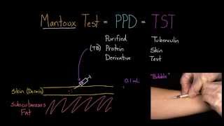 Mantoux Test aka PPD or TST [upl. by Htebi]