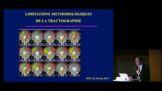 La neurochirurgie éveillée [upl. by Brenn]