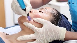 Microneedling Full Training Video [upl. by Audris]