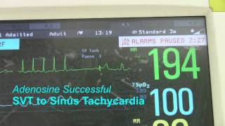 SVT or Supraventricular Tachycardia [upl. by Padegs344]