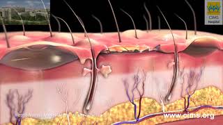 Burns Classification and Treatment – CIMS Hospital [upl. by Aneerol]