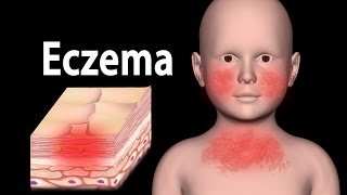 Eczema Animation [upl. by Ordnasela]