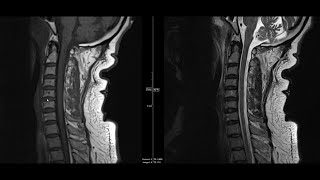 Cervical Lymph Node Levels in 5 minutes [upl. by Aniaz]