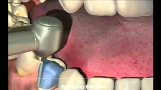 Crowns  Procedure for your new crown at Dental Reflections [upl. by Iluj537]