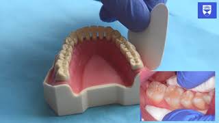 Technique for placing a resin fissure sealant [upl. by Sweet738]