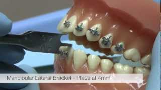 American Orthodontics Alexander LTS Brackets  Bracket Placement Video [upl. by Bezanson]