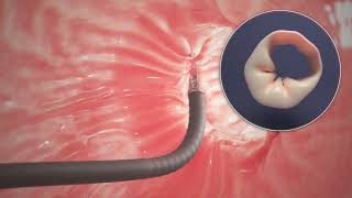 Endoscopic Sleeve Gastroplasty ESG Procedure Animation [upl. by Randa]