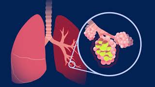 Understanding Pneumococcal Pneumonia [upl. by Chaffin670]