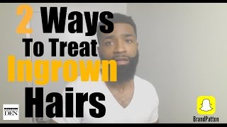 2 Ways To Treat Ingrown Hairs In 2 Minutes [upl. by Houlberg]