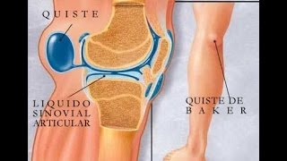 Quiste de Baker o popliteo Rodilla [upl. by Eniretak]