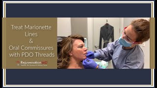 Treating Marionette Lines and Oral Commissures with PDO Threads [upl. by Nelyaw]