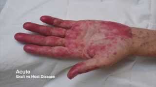 Chromoblastomycosis Dematiaceous Black Mold Fungus Skin Infection 5Minute Pathology Pearls [upl. by Blader]