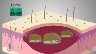 Vídeo explicativo sobre los Biofilms y como actúa Prontosan [upl. by Pattison]