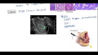 Laparoscopic Pelvic and Aortic Lymphadenectomy [upl. by Noscire]