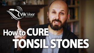 How to Cure Tonsil Stones [upl. by Lleze]