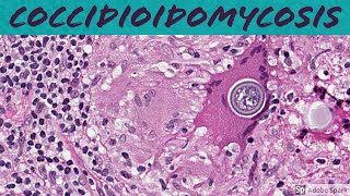 Coccidioidomycosis Coccidioides 5Minute Pathology Pearls [upl. by Castera]