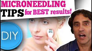 MICRONEEDLING DIY at HOME  What You Need to Know [upl. by Coral749]