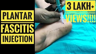 Plantar Fascitis Injection Technique [upl. by Melas139]