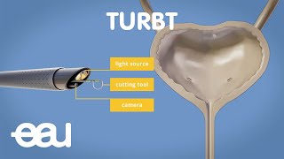 Bladder cancer treatment TURBT [upl. by Casey]