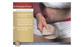 ColostomyIleostomy Changing a Pouch [upl. by Acinorev]