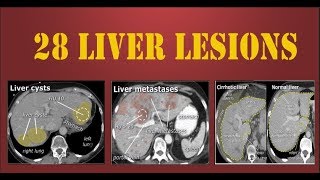 Liver Cancer  All Symptoms [upl. by Cameron464]