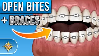 How Do Braces Fix Open Bites  Premier Orthodontics [upl. by Bonnette]