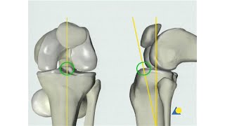 Tibia  Fracture  Intramedullary Nailing with the Expert Tibial Nail Without Reaming [upl. by Stanfield]