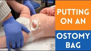 Applying an Ostomy Bag [upl. by Ahsyekat]