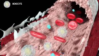 Development of atherosclerosis [upl. by Debo]