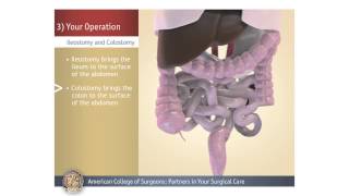 ColostomyIleostomy Your Operation [upl. by Nilo253]