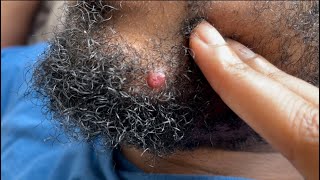 Enlarged Bump on beard ingrown hairs [upl. by Merriott758]