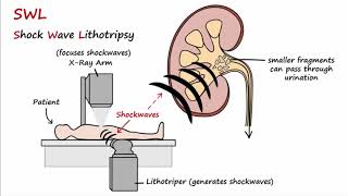 Nephrolithiasis  Medical Meaning and Pronunciation [upl. by Einnor]