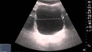 Ultrasound Estimated PostVoid Residual Bladder [upl. by Elleniad]