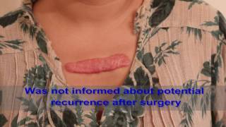 Chest Keloids  Mistakes to Avoid [upl. by Auhoj]