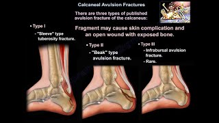 Calcaneal Avulsion Fractures  Everything You Need To Know  Dr Nabil Ebraheim [upl. by Llenyl]