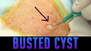 Preauricular Cyst Infection Management [upl. by Teryn]